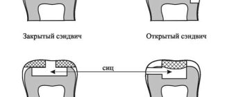 Сэндвич техника в стоматологии: эффективность и преимущества