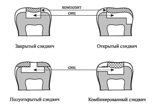 Сэндвич техника в стоматологии: особенности и применение