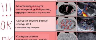 Серозная цистаденома яичника: характеристика и диагностическое значение