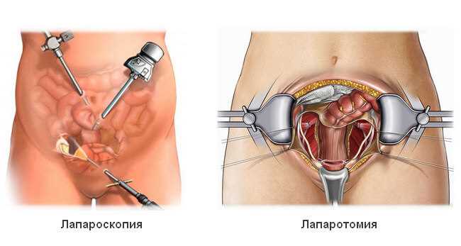 Симптомы серозоцеле