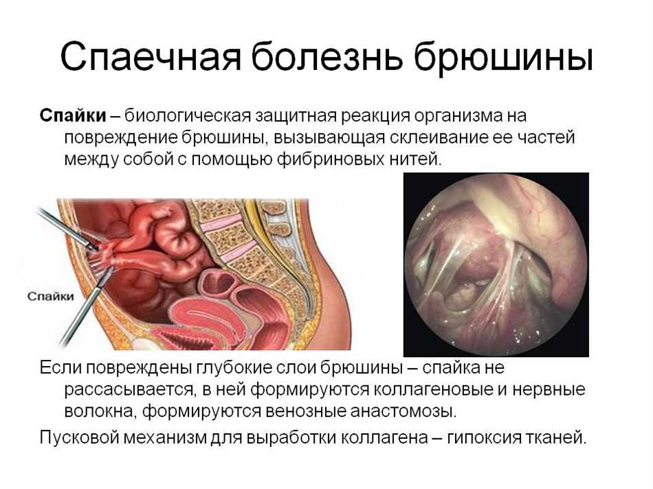 Симптомы серозоцеле в малом тазу