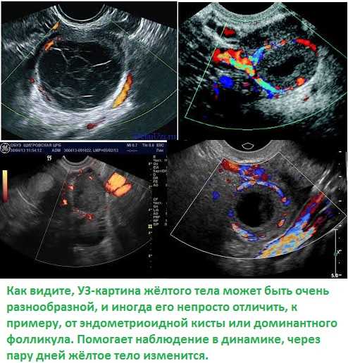 Серозоцеле в малом тазу: что это такое