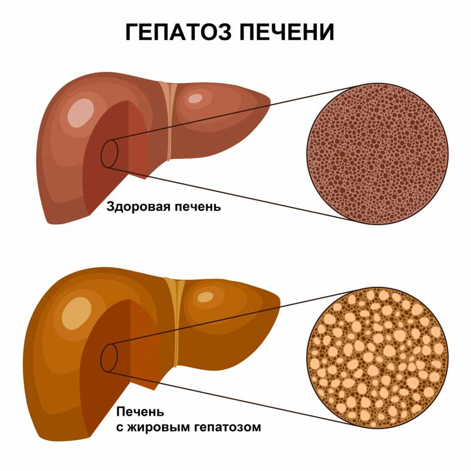 Гепатоз печени причины и симптомы